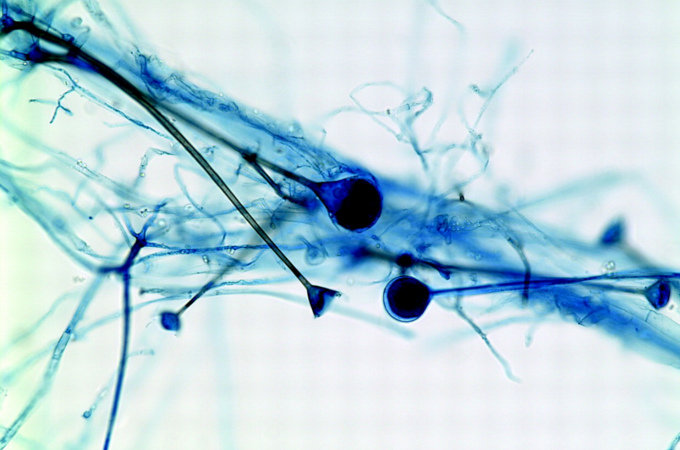 世界各地で報告される「最恐の病原菌」5選が絶望的すぎる! 肉体を壊死させ脳を侵食、治療も困難…!の画像3