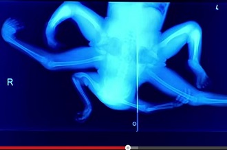 4本の手と4本の足 ― インド人幼女「結合双生児」のドキュメンタリーの画像3