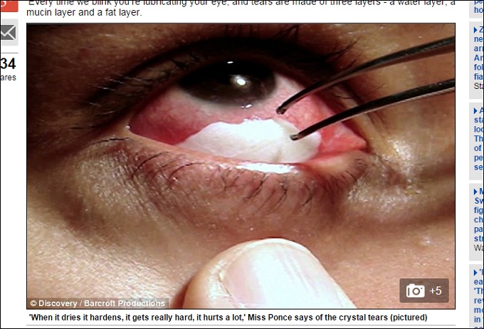 「白くて硬い結晶の涙」を流す女性の苦難！ 20年苦しみ抜いて判明した衝撃の成分の画像2