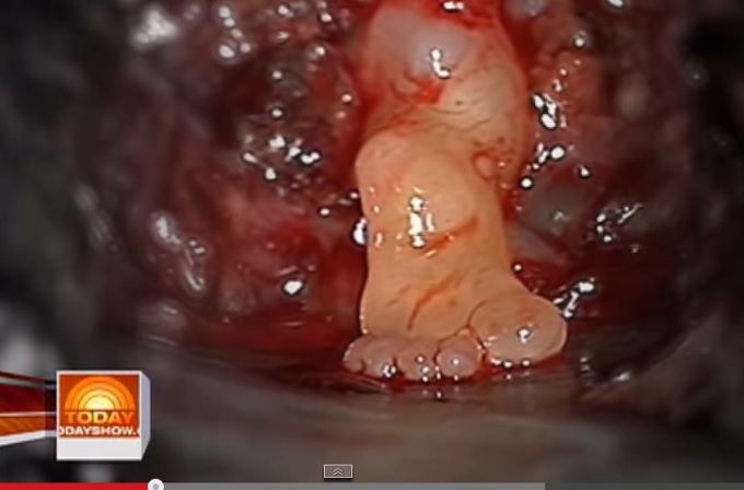 「脳から足が生えた赤ん坊」に戦慄! 医師も凍りついた人体の奇跡、2つの可能性とは!?の画像2