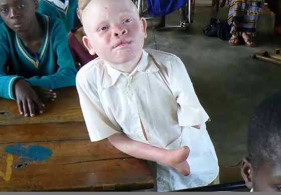 父親が息子の右手を切り落とす ― 止まぬアルビノの少年少女襲撃事件＝東アフリカの画像1