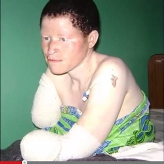 父親が息子の右手を切り落とす ― 止まぬアルビノの少年少女襲撃事件＝東アフリカの画像2