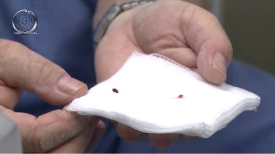 宇宙人が人間の身体に異物を埋め込んだ数々の証拠！ すべて磁気を帯びており…恐るべきエイリアン・インプラントの実態！の画像2