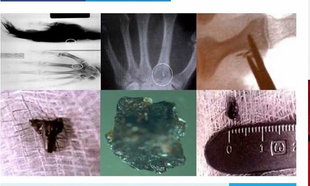 宇宙人が人間の身体に異物を埋め込んだ数々の証拠！ すべて磁気を帯びており…恐るべきエイリアン・インプラントの実態！の画像3