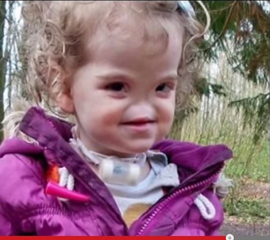【無鼻症】生まれつき鼻が無いかわいい少女 ― 鼻骨インプラント手術に成功＝アイルランドの画像1