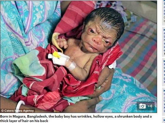 4億人に1人の奇跡か!? 80歳の姿で生まれるリアル「ベンジャミン・バトン」事例、プロジェリア症候群がまたも発生！＝バングラデシュの画像1