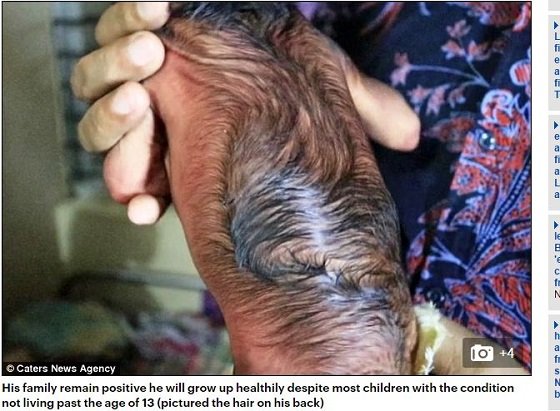 4億人に1人の奇跡か!? 80歳の姿で生まれるリアル「ベンジャミン・バトン」事例、プロジェリア症候群がまたも発生！＝バングラデシュの画像2