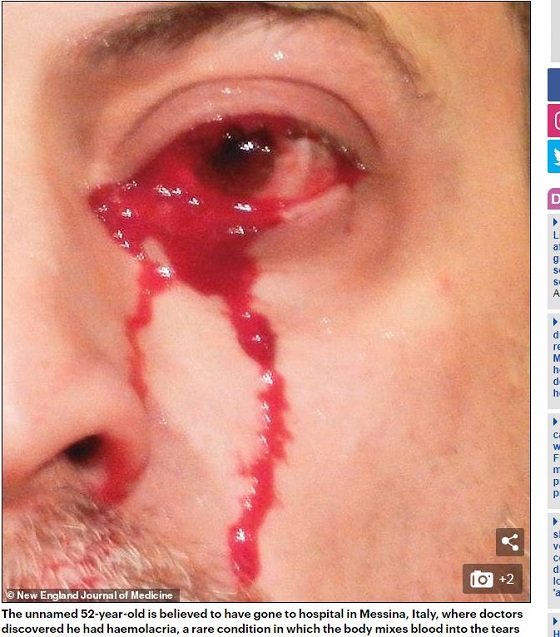 血の涙を流す謎の「ヘモラクリア」 1時間以上「血の涙」を流し続けた男の謎、鼻をつまむと耳から血が出ることもの画像1