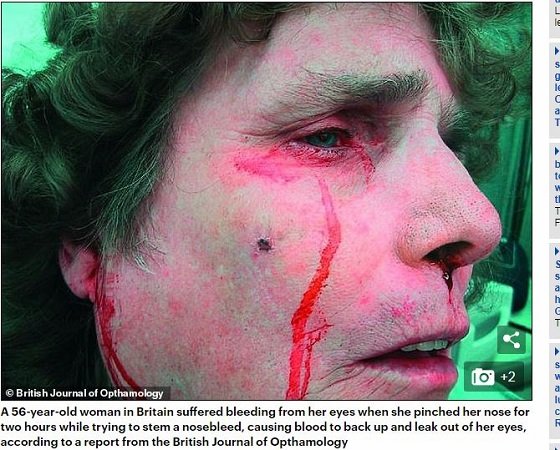 血の涙を流す謎の「ヘモラクリア」 1時間以上「血の涙」を流し続けた男の謎、鼻をつまむと耳から血が出ることもの画像2