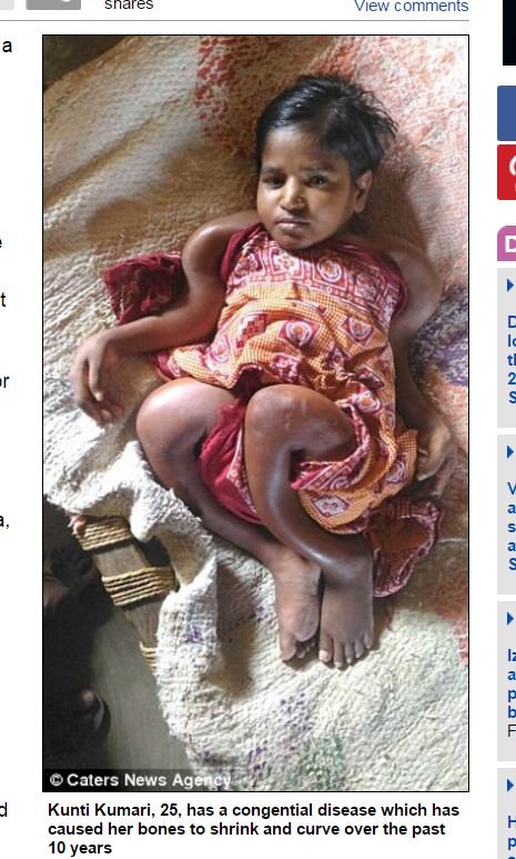 身長61cmの生ける死骸 ― 全身の骨がぐにゃぐにゃになる「骨形成不全症」の恐怖の画像1