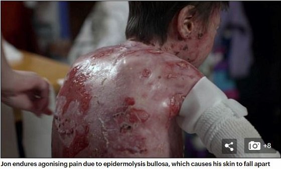 【奇病】全身の皮膚がズルむける「バタフライボーイ」の想像を絶する激痛！ ハイパー治療法「幹細胞遺伝子」で回復なるかの画像2