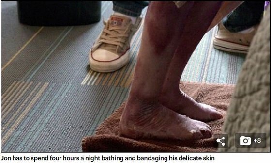 【奇病】全身の皮膚がズルむける「バタフライボーイ」の想像を絶する激痛！ ハイパー治療法「幹細胞遺伝子」で回復なるかの画像3