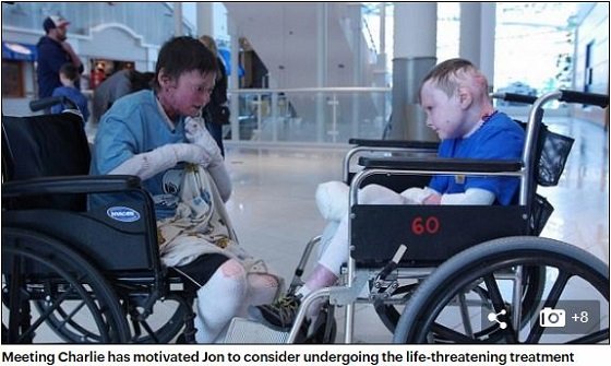 【奇病】全身の皮膚がズルむける「バタフライボーイ」の想像を絶する激痛！ ハイパー治療法「幹細胞遺伝子」で回復なるかの画像4