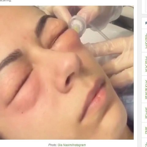 YouTubeで話題の「人面ふうせん」！ 美しくなるために炭酸ガスを目元に注射するカルボキシセラピーとは？の画像1