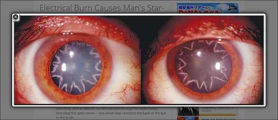 瞳にキラキラの星型模様が出た男！！原因は恋ではなく……驚愕の症例報告！の画像1