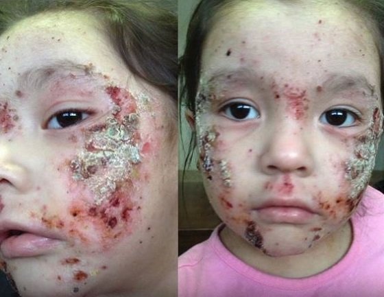 水の汚染が原因で恐怖の皮膚病が流行？ 政府は否定・隠蔽で、カナダ先住民がブチギレ！の画像1