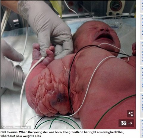 クローヴス症候群 ― 上半身の膨張が止まらない少女、5000万人に1人の「ベビー・ハルク」と呼ばれての画像1