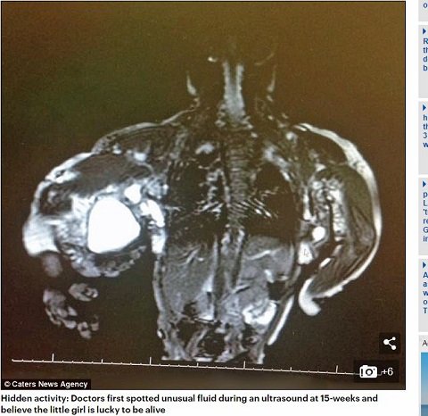 クローヴス症候群 ― 上半身の膨張が止まらない少女、5000万人に1人の「ベビー・ハルク」と呼ばれての画像2