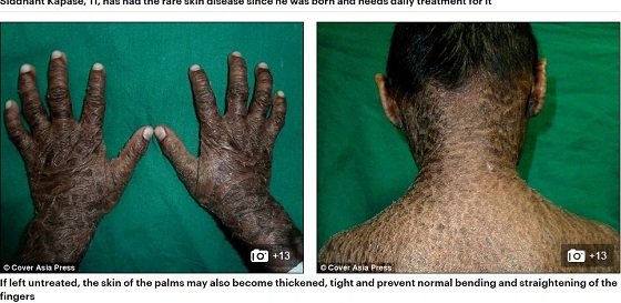 ウロコで全身を覆われた姉弟 ― 皮膚がひび割れ、剥がれ落ちる難病と徹底的差別の実態＝インドの画像2