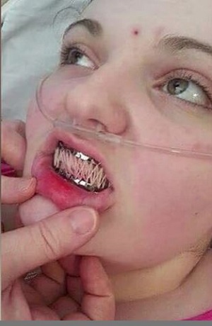 エーラス・ダンロス症候群 ― 身体がバラバラになる少女は口も縫い合わせる＝イギリスの画像2