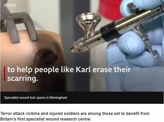 電流でビビビッと傷を4倍早く治す「電子ばんそうこう」爆誕へ！ もはや湿潤療法も時代遅れ！の画像1