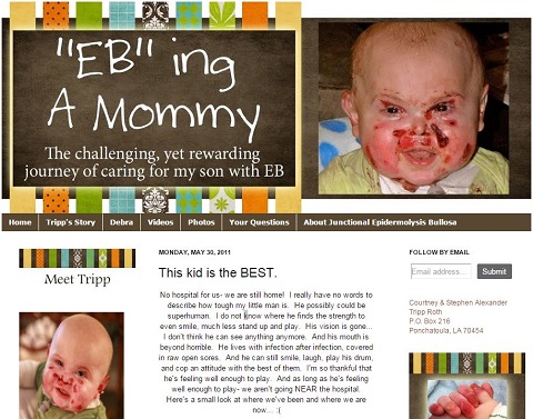 愛する我が子がチャッキーになっていく！ 恐怖の皮膚疾患「EBウイルス」と闘う子どもたちの画像2