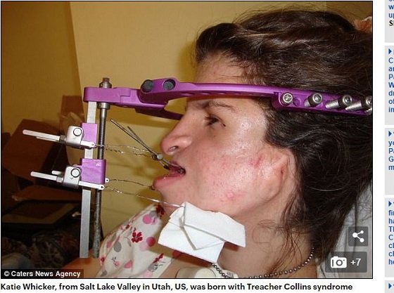 トリーチャー・コリンズ症候群の顔面崩壊女 ― いじめ・差別を乗り越え56回の手術で回復の兆し、その全記録の画像2