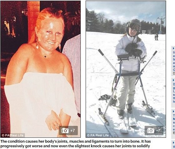 全身が石像になる不治の病「FOP」 ― 平均寿命41歳。それでもホイットニーは普通の人以上に努力し続けるの画像1