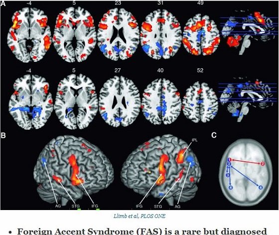 頭痛で起きたら英国なまりになっていた米国人！ モノマネではない… 奇病「外国語様アクセント症候群」の謎とは？の画像5