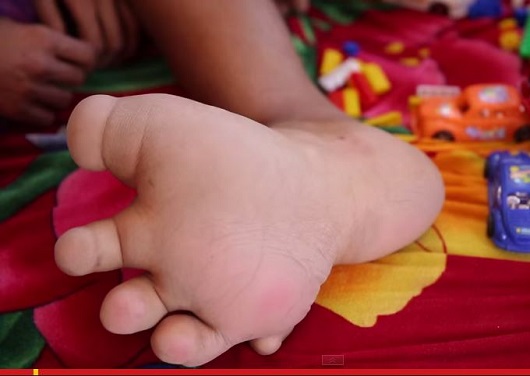 右足が超巨大化した少年、学校側から通学を拒否される「子どもたちが怖がるから」＝インドの画像1