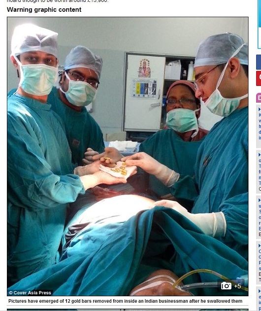 密輸失敗！ 「金の延べ棒」丸呑み男の悲しい顛末!!の画像1