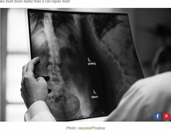 体内で骨がゆっくり消えゆく奇病「ゴーハム病」 ― 原因は完全不明、遺伝でもなく… まさに生き地獄ノ病状とは!?の画像1