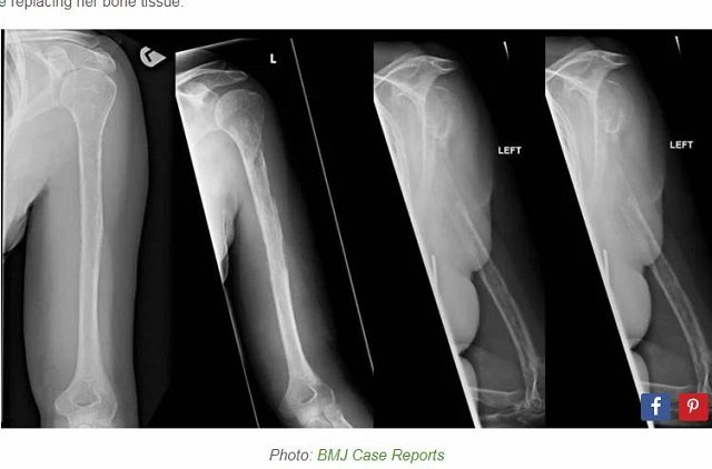 体内で骨がゆっくり消えゆく奇病「ゴーハム病」 ― 原因は完全不明、遺伝でもなく… まさに生き地獄ノ病状とは!?の画像2