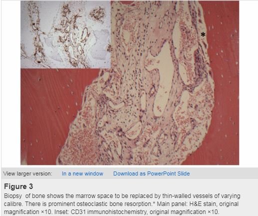 体内で骨がゆっくり消えゆく奇病「ゴーハム病」 ― 原因は完全不明、遺伝でもなく… まさに生き地獄ノ病状とは!?の画像3