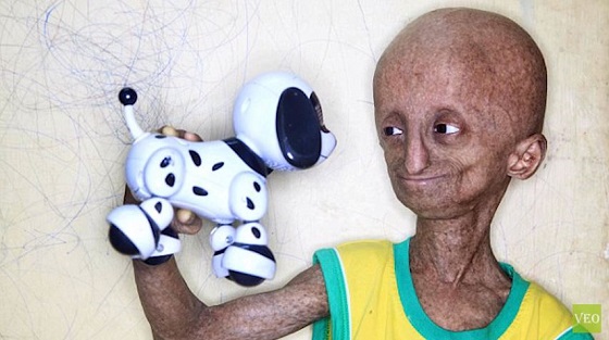 8倍の速さで年老いた14歳の少年（112歳）が語った「死ぬ前にしたい3のこと」の画像1