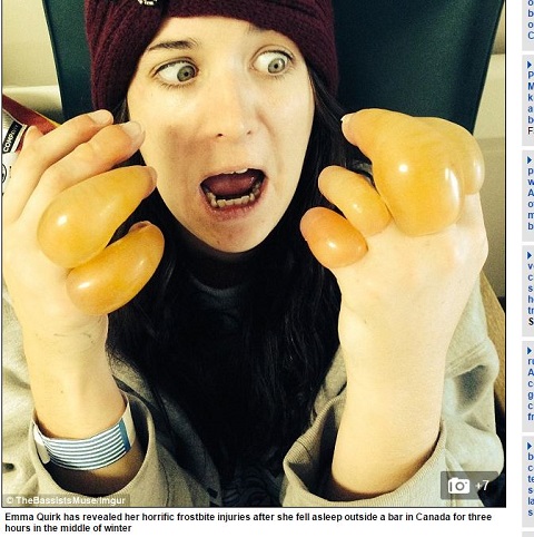 【閲覧注意】泥酔したまま、マイナス30度の屋外で眠った女性の末路がトンでもなさ過ぎたの画像1