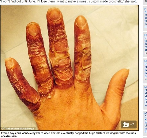 【閲覧注意】泥酔したまま、マイナス30度の屋外で眠った女性の末路がトンでもなさ過ぎたの画像2