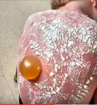 【閲覧注意？】日焼けでできた巨大水ぶくれがヤバすぎる!! 死をも招く恐怖の紫外線!!＝米・オクラホマの画像2