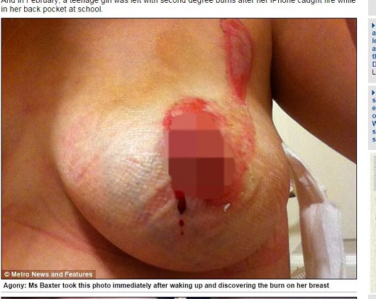 【iPhone 6は大丈夫？】胸にまさかの大ヤケド！ iPhone充電中に起きた大悲劇の画像2