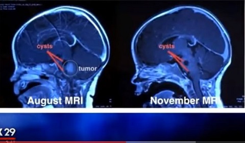 ローマ教皇フランシスコの祝福の接吻で幼女の脳腫瘍がみるみる縮小？MRI検査で判明！　の画像2