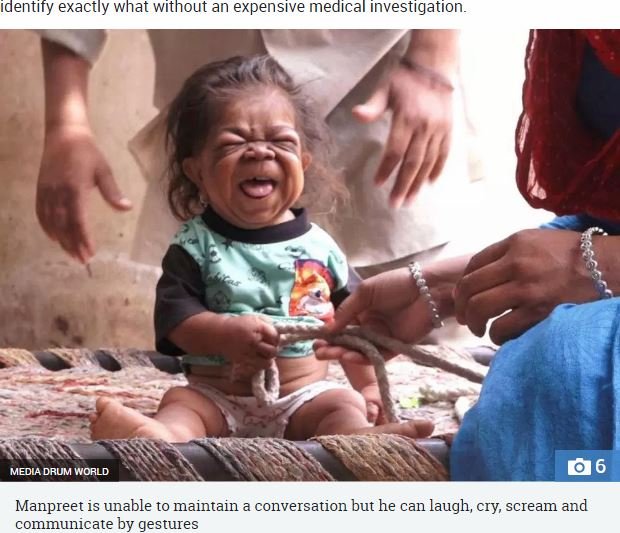 赤ん坊の身体に閉じ込められた23歳の男 ― 身長46センチ、体重5キロ…奇病「ラロン症候群」か!?の画像1