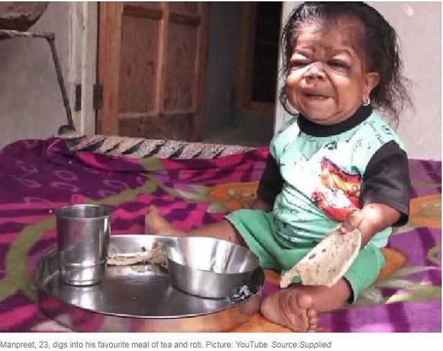 赤ん坊の身体に閉じ込められた23歳の男 ― 身長46センチ、体重5キロ…奇病「ラロン症候群」か!?の画像4