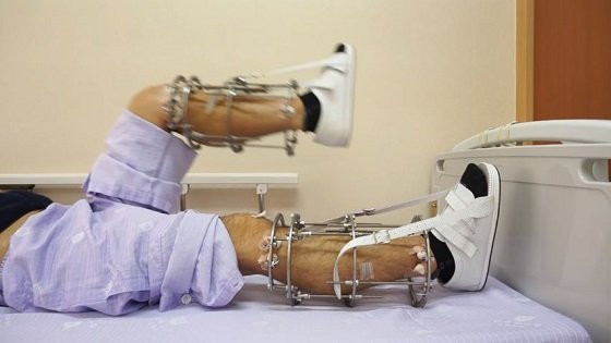 インドの短足手術がヤバすぎる！ 164センチが182センチへ…観光客殺到も危険がいっぱいの画像1