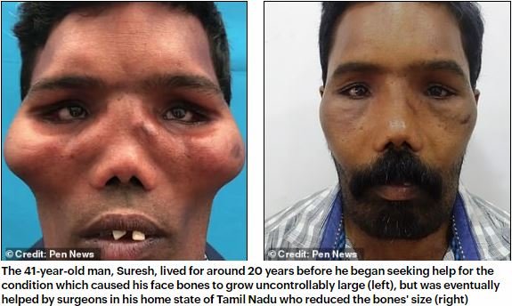 突然顔が変形&巨大化する「ライオン病」の謎！ 現代医療に見放された患者の苦悩＝印の画像1