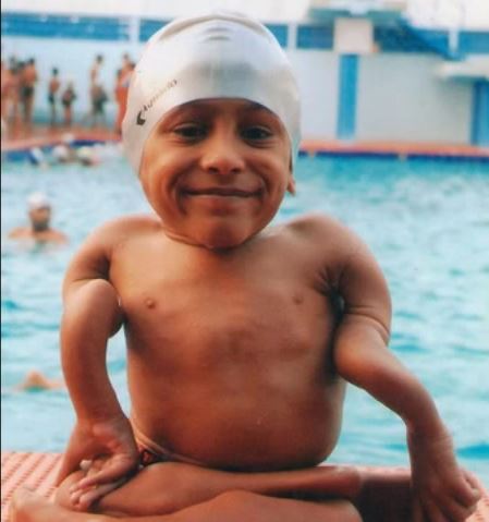 本当にグニャグニャの18歳少年 ― 身長45センチ骨折回数300を超えるスイマーの画像1