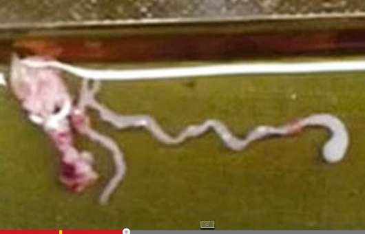 頭痛と痙攣に悩む11歳少年の脳から寄生虫！ 中国の食肉に潜んでいた「芽殖孤虫」の恐怖!!の画像1