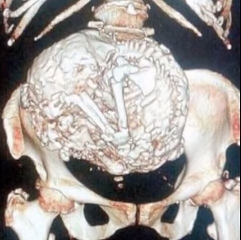 出産はもう無理？50年間ずっと妊娠している91歳の老婆！＝チリの画像1