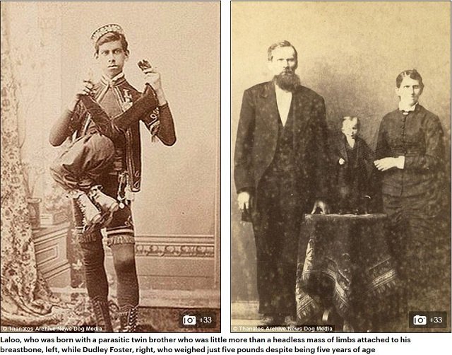 巨人症、アルビノ、結合双生児… 奇形を見世物にした19世紀のフリークショー出演者たち19人大集合！の画像5