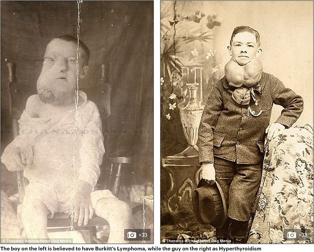 巨人症、アルビノ、結合双生児… 奇形を見世物にした19世紀のフリークショー出演者たち19人大集合！の画像6