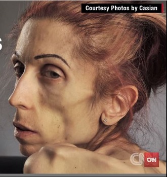 【拒食症】身長170cm体重18キロ ― 米国人女優を「死のダイエット」に駆り立てたものとは？の画像1